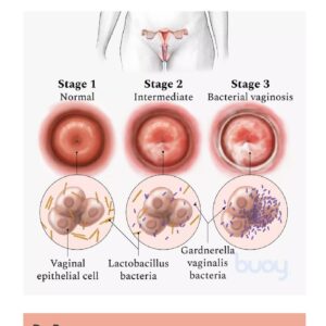 BACTERIAL VAGINOSIS 4 WOMEN - Antibacterial, Anti-inflammatory - to Treat and Prevent - Image 4