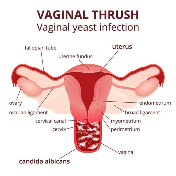 VAGINAL YEAST INFECTION & CANDIDIASIS - TREAT & PREVENT - MADE IN USA - Image 2