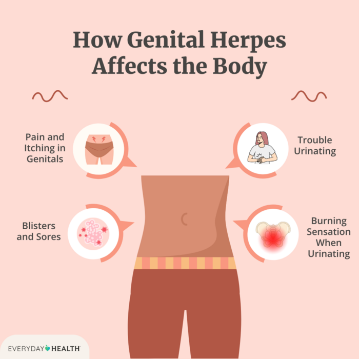 GENITAL HERPES 1 & 2 PAIN RELIEF - EXTRA STRENGTH - 120 Caps - MADE IN USA - Image 4