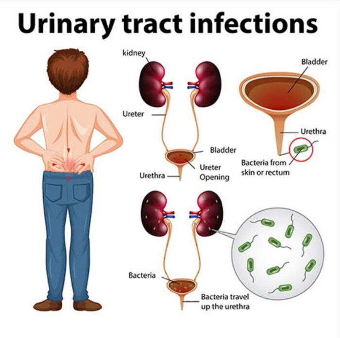 URINARY TRACT INFECTION - UTIs - MEN & WOMEN - TREAT & PREVENT - 60 GUMMIES - Image 6